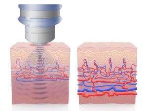 Penis Enlargement with Modus ED SWT Shock Wave Therapy