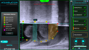 Aquablation Therapy Surgical Map