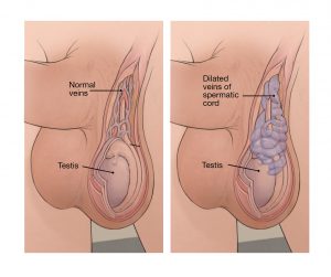 Varicocele