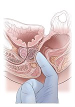 Prostate Cancer Screening Diagram