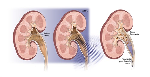 shock wave lithotripsy diagram