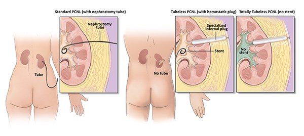 diagram of pcnl