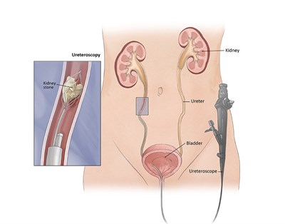 uretoscopy diagram