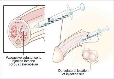 Needle Penis