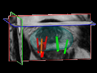 PROMAP-MR