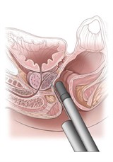 prostate biopsy