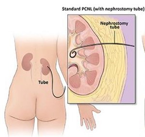 pcnl graphic