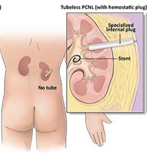 tubeless pcnl