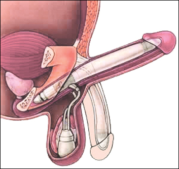 penile prostheses