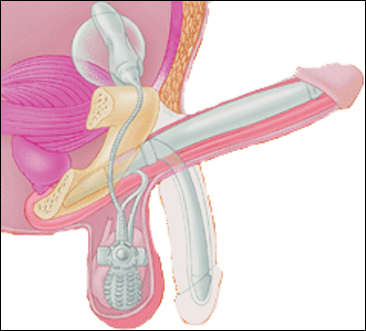 penile prostheses