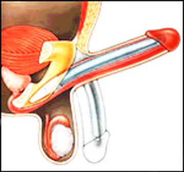 penile prostheses