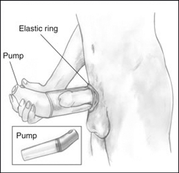 vacuum erection device