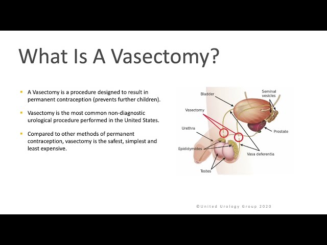 research article on vasectomy