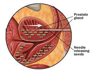 Prostate Gland