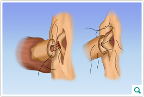 epididymovasostomy_inset