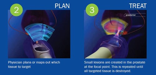 HIFU Planning Diagram