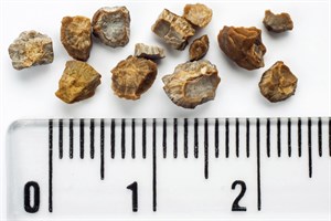 Kidney Stones