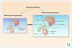Vasectomy Reversal Inset