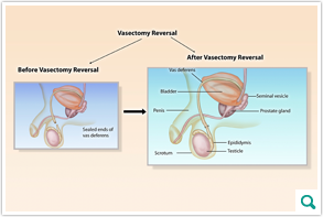 vasectomyreversal_inset