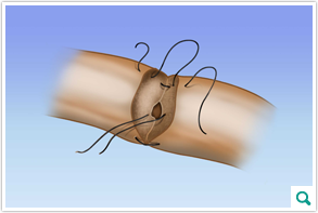 vasovasostomy_inset